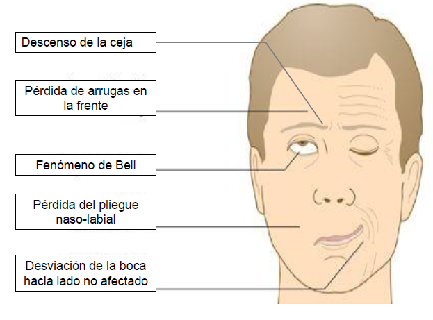 parálisis facial